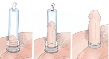 Pompa kullanarak penis büyütme